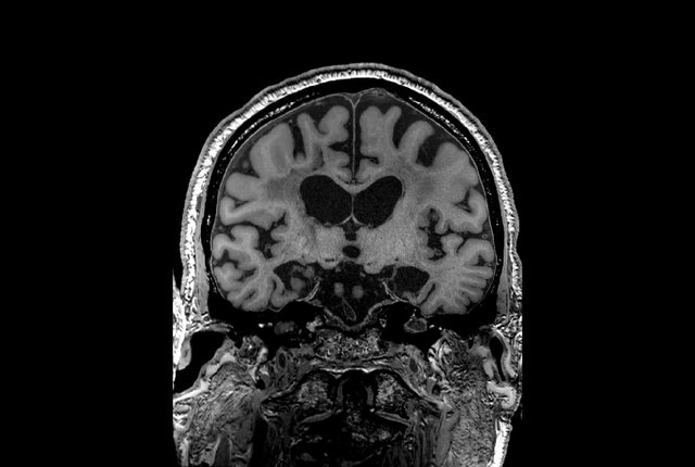 H.M. in situ MRI scan in the coronal plane H.M. in situ MRI scan in the coronal plane